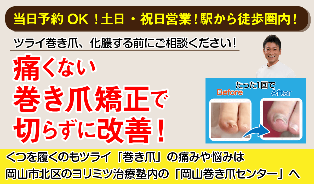 巻き爪でお悩みのあなたへ