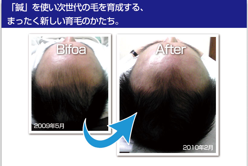 頭皮鍼before_After